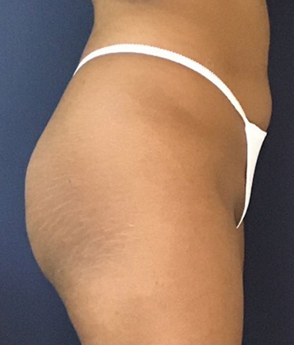 Brazilian Buttock Augmentation Before & After Gallery - Patient 13732967 - Image 5