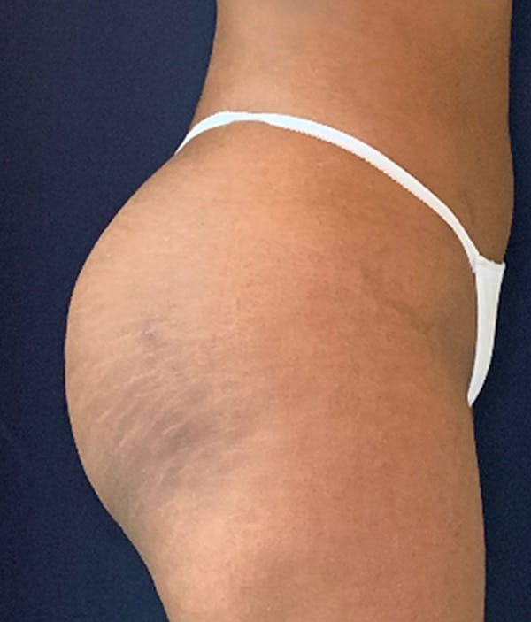 Brazilian Buttock Augmentation Before & After Gallery - Patient 13732967 - Image 6