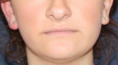 Lip Augmentation Before & After Gallery - Patient 13825819 - Image 1