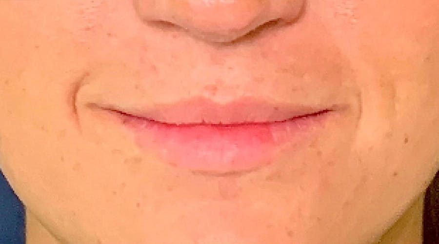 Lip Augmentation Before & After Gallery - Patient 13825820 - Image 1