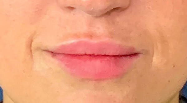 Lip Augmentation Before & After Gallery - Patient 13825820 - Image 2