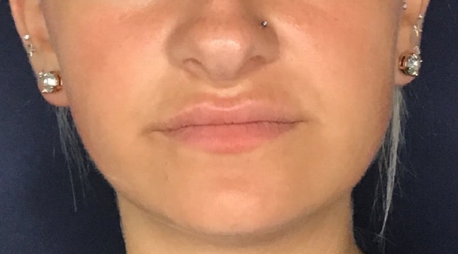 Lip Augmentation Before & After Gallery - Patient 13825819 - Image 2