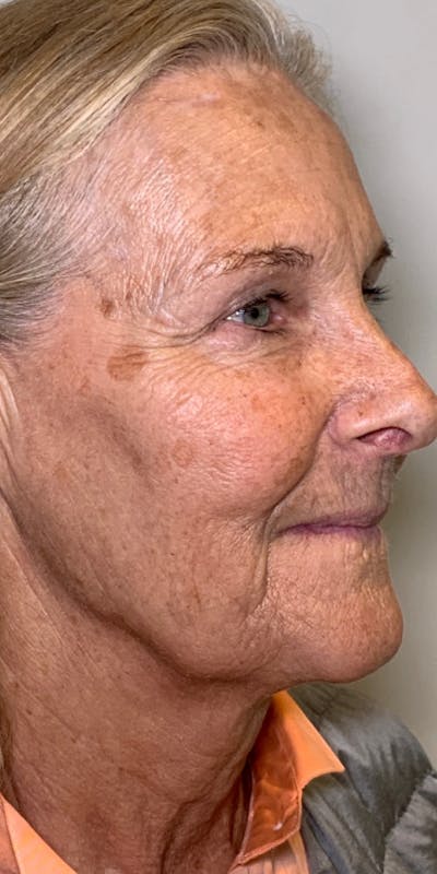 Sciton® BBL™ Before & After Gallery - Patient 13948516 - Image 1