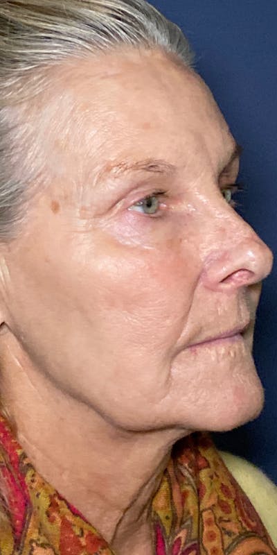 Sciton® BBL™ Before & After Gallery - Patient 13948516 - Image 2
