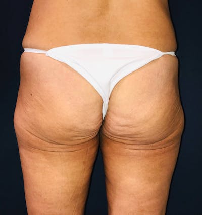 Brazilian Buttock Augmentation Gallery - Patient 14153196 - Image 1