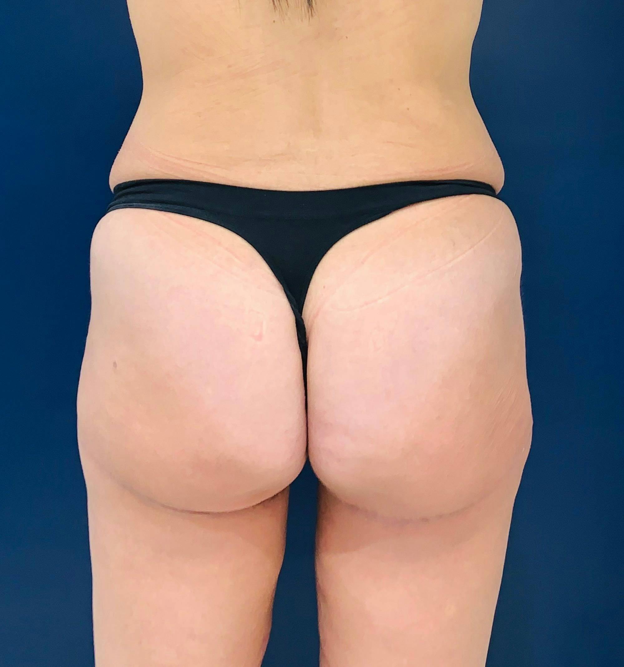 Brazilian Buttock Augmentation Gallery - Patient 14153196 - Image 2