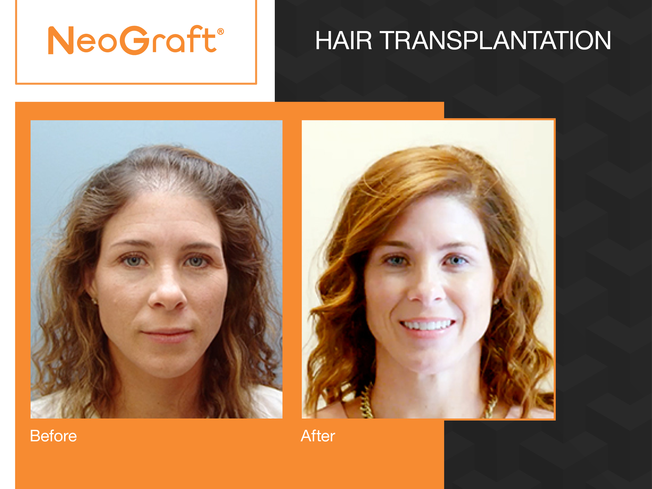 NeoGraft before and after of a woman's hair.
