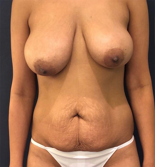 Mommy Makeover before and afters by Dr. Alizadeh