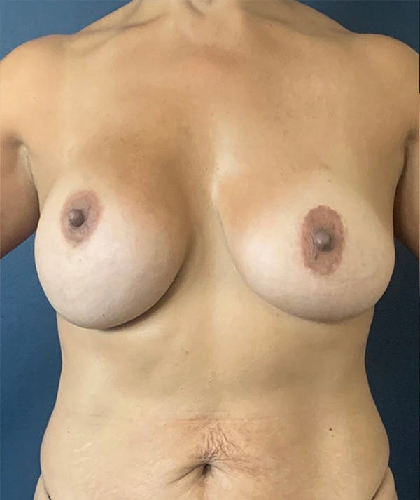 Breast Revision Gallery - Patient 18113830 - Image 1