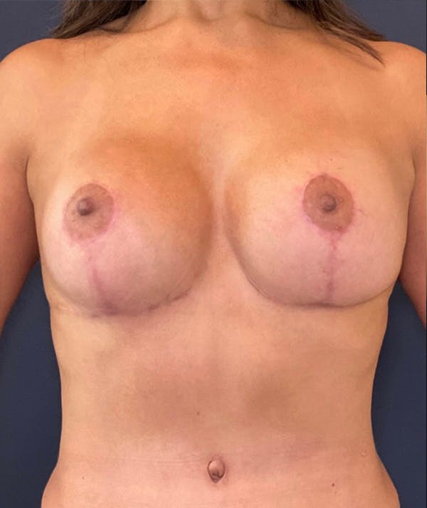 Breast Revision Gallery - Patient 18113830 - Image 2