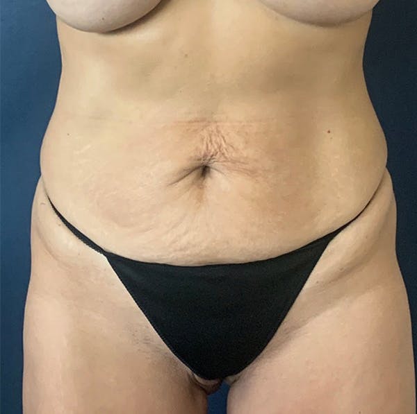 Tummy Tuck (Abdominoplasty) Before & After Gallery - Patient 18113797 - Image 1