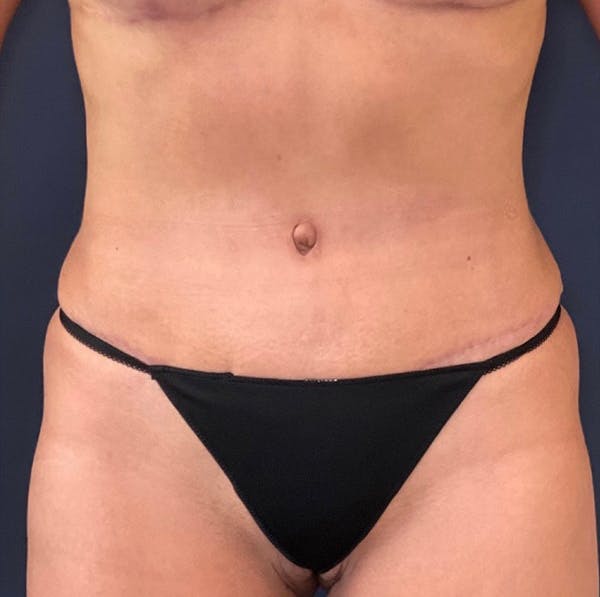 Tummy Tuck (Abdominoplasty) Before & After Gallery - Patient 18113797 - Image 2