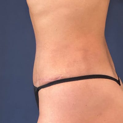 Tummy Tuck (Abdominoplasty) Before & After Gallery - Patient 18113797 - Image 6