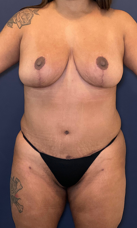 After Mommy Makeover with Dr. Alizadeh.