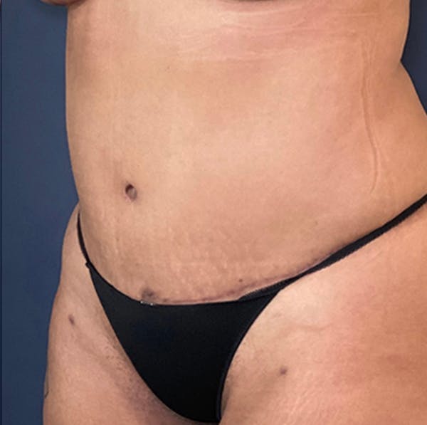 Tummy Tuck (Abdominoplasty) Gallery - Patient 18114256 - Image 4