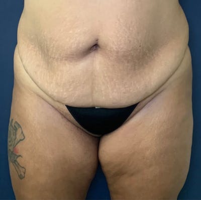 Liposuction Gallery - Patient 18114264 - Image 1