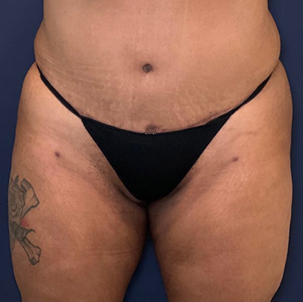 Liposuction Gallery - Patient 18114264 - Image 2