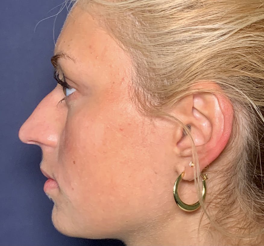 Patient 2 Before Non-Surgical Rhinoplasty