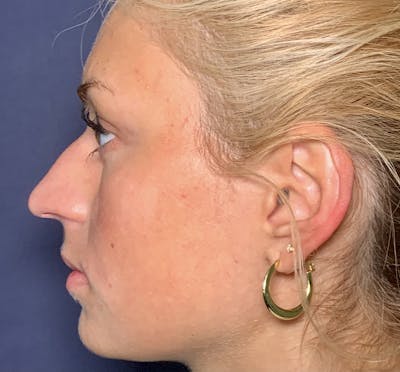 Patient 1 Before Non-Surgical Rhinoplasty
