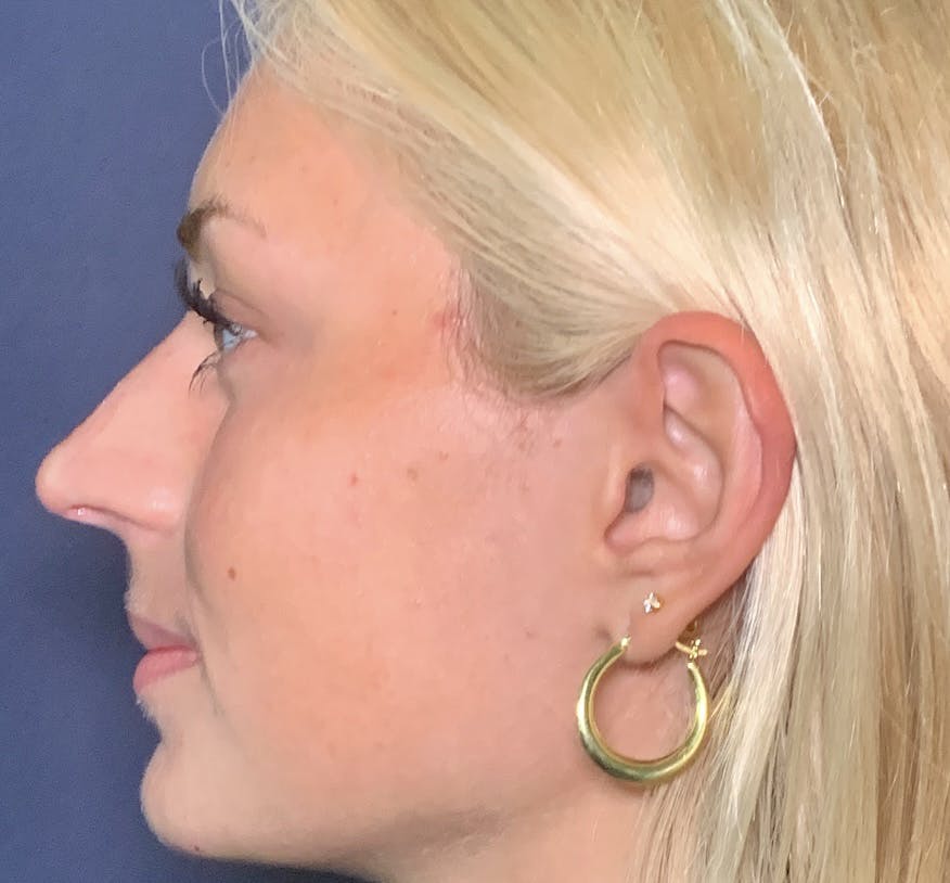 Patient 2 After Non-Surgical Rhinoplasty
