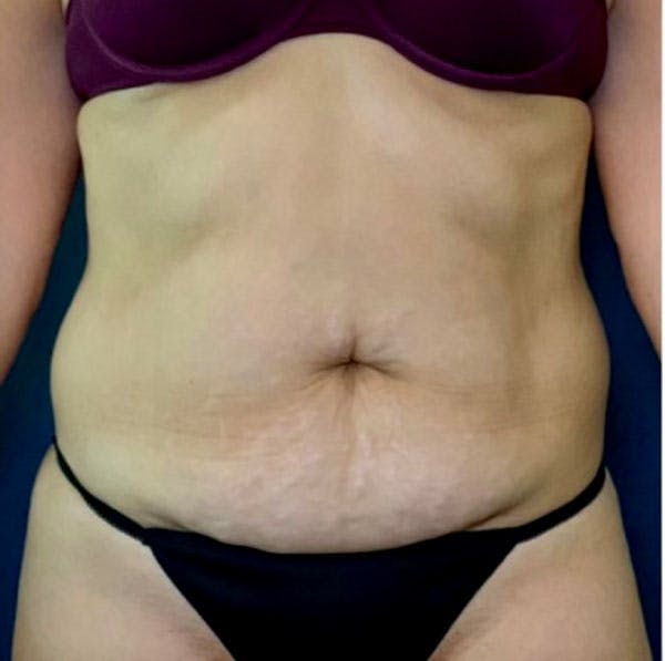 Tummy Tuck (Abdominoplasty) Before & After Gallery - Patient 41594257 - Image 1