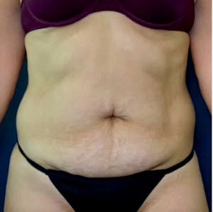 Tummy Tuck Before and After Images