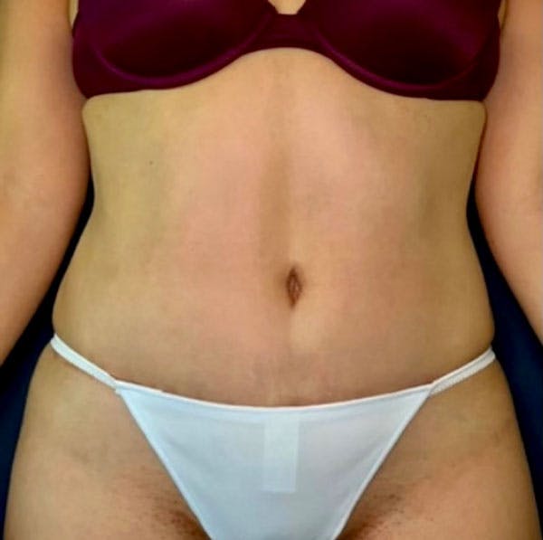Tummy Tuck (Abdominoplasty) Before & After Gallery - Patient 41594257 - Image 2