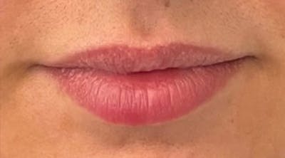 Lip Augmentation Before & After Gallery - Patient 43421764 - Image 1