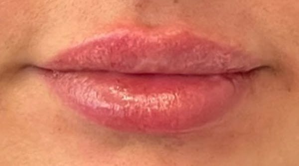 Lip Augmentation Before & After Gallery - Patient 43421764 - Image 2