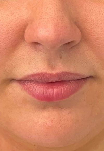 Dermal Fillers Before & After Gallery - Patient 43626304 - Image 1