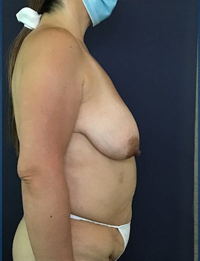 Mommy Makeover Before & After Gallery - Patient 50320694 - Image 1