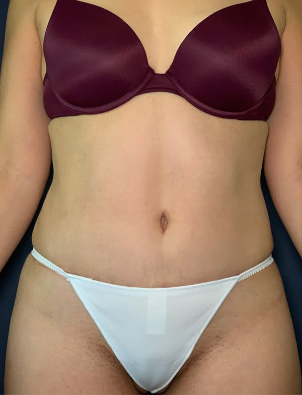 Mommy Makeover Gallery - Patient 50320697 - Image 2