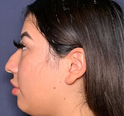 Patient 2 Before Non-Surgical Rhinoplasty