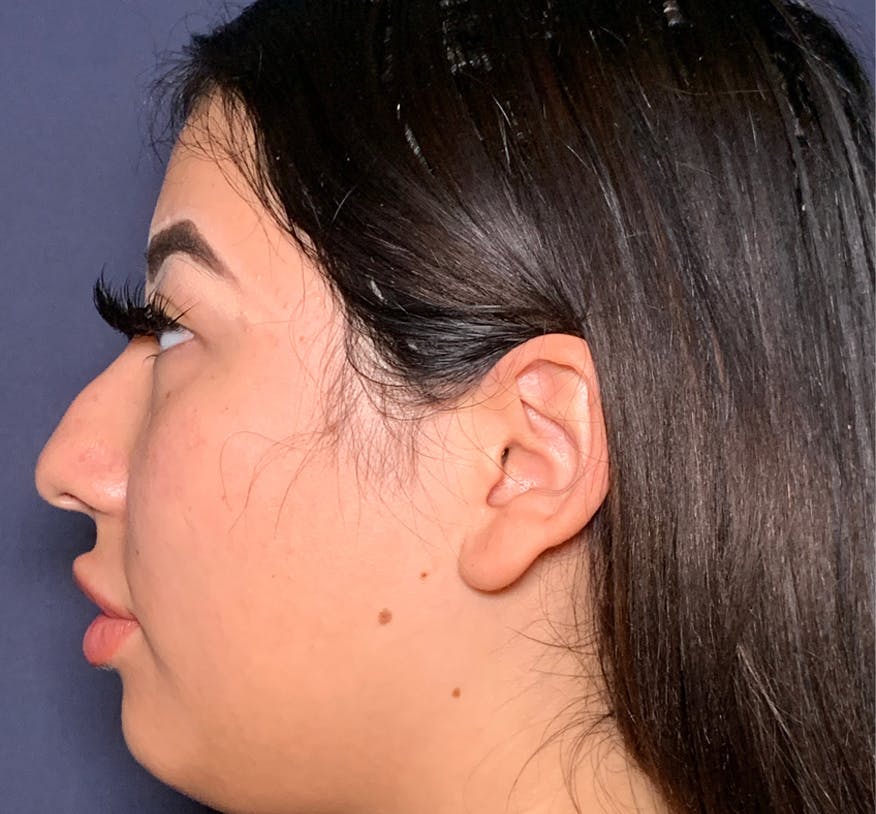 Patient 3 Before Non-Surgical Rhinoplasty