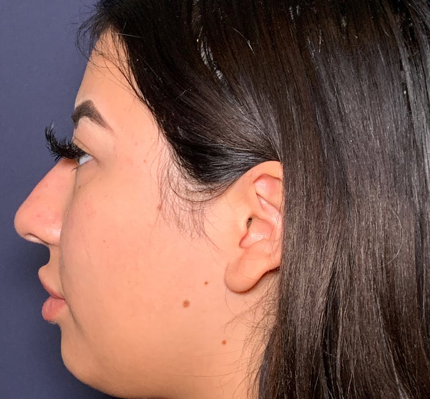 Patient 2 After Non-Surgical Rhinoplasty