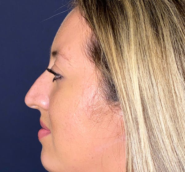 Patient 3 After Non-Surgical Rhinoplasty