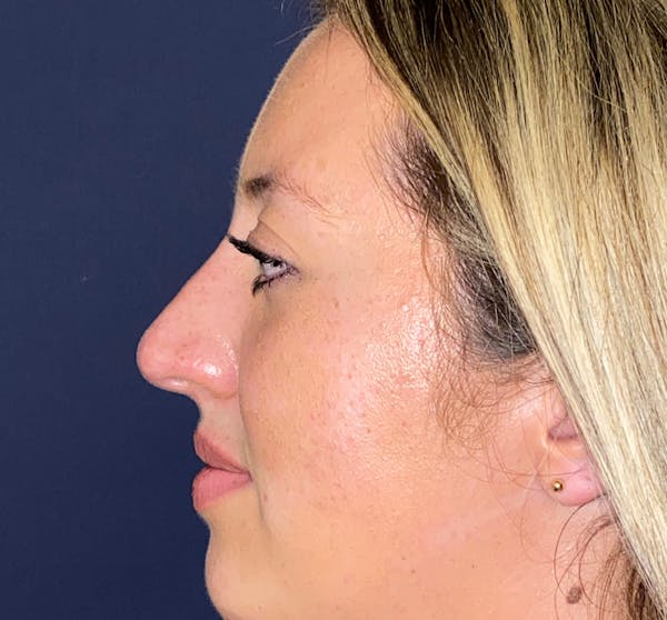 Patient 3 Before Non-Surgical Rhinoplasty