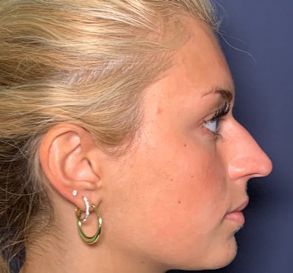 Dermal Fillers Before & After Gallery - Patient 141526116 - Image 3