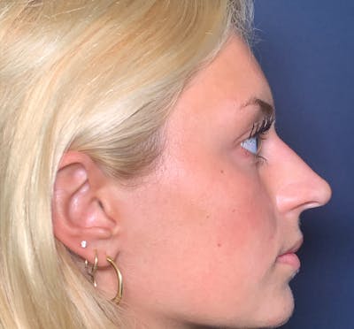  Liquid Rhinoplasty Before & After Gallery - Patient 41037003 - Image 4