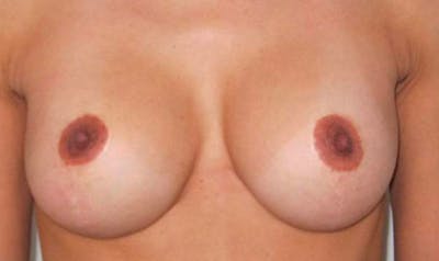 NYC Breast Lift - After Photo