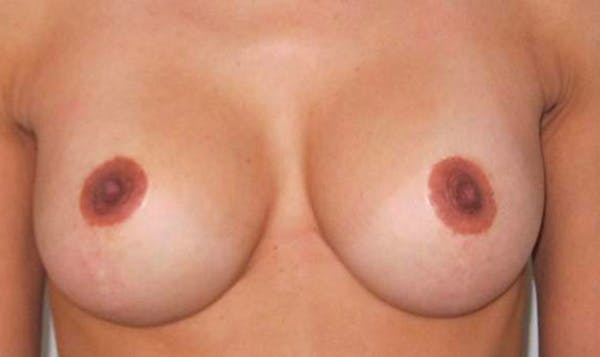 NYC Breast Lift - After Photo