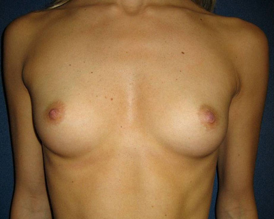 Patient 1 Before Breast Augmentation