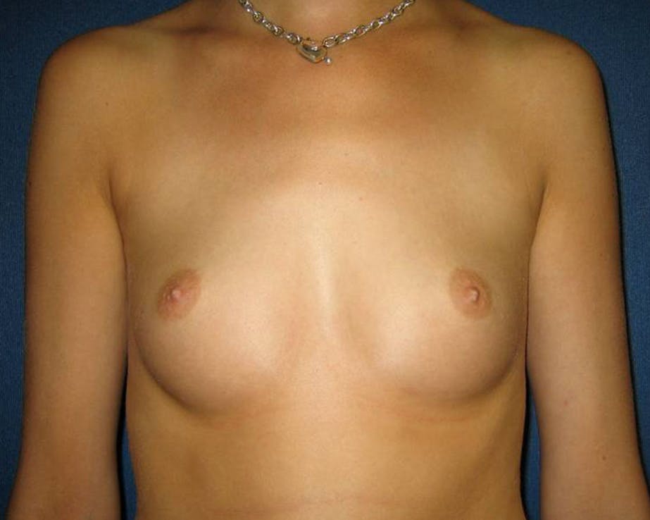 Patient 3 Before Breast Augmentation