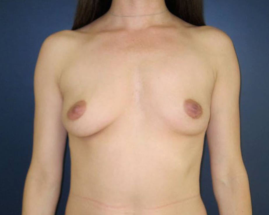 Patient 4 Before Breast Augmentation