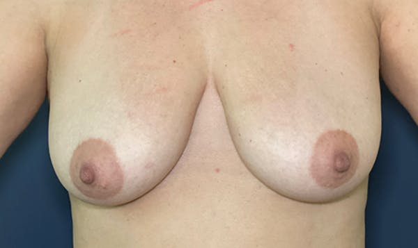 NaturaBra™ Mastopexy Before & After Gallery - Patient 51852597 - Image 1