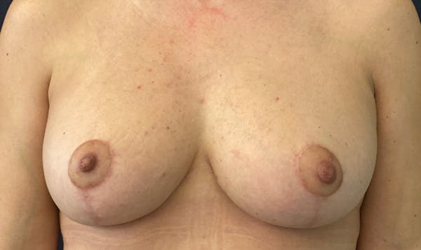 NaturaBra® Mastopexy Before & After Gallery - Patient 51852597 - Image 2