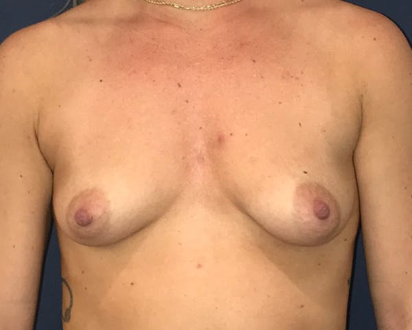 Breast Augmentation Before & After Gallery - Patient 51852603 - Image 1