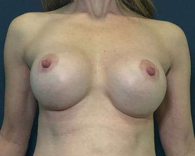Breast Augmentation Gallery - Patient 51852605 - Image 2