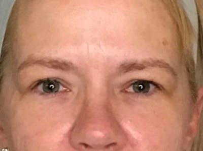 Blepharoplasty (Eyelid Surgery) Before & After Gallery - Patient 13733123 - Image 1