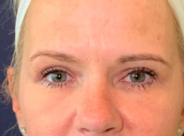 Blepharoplasty (Eyelid Surgery) Before & After Gallery - Patient 13733123 - Image 2